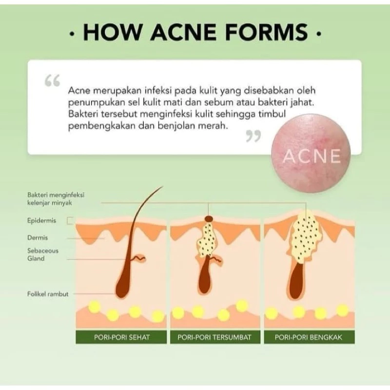 you acne plus berjerawat skin defense moisturizer 25g you acne plus berjerawat skin defense moisturizer 25g